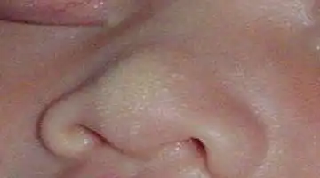 刚出生的宝宝鼻子上有很多小白点,应该怎么办看完松了一口气
