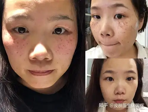 重庆激光祛斑一般多少钱雀斑,求推荐三甲医院医生